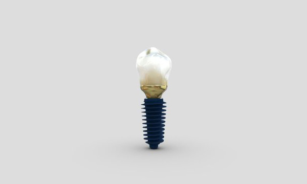 Anyridge Dental Implant